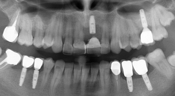 Caz complex reabilitare orala totala - implanturi Ankylos plasate in zonele masticatorie si estetica