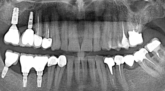 Caz reabilitare orala totala - aditie osoasa si implanturi Ankylos